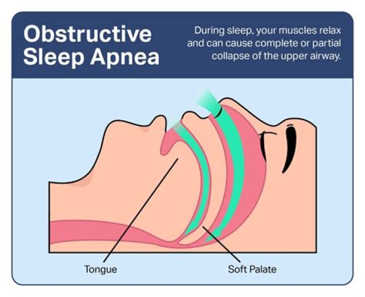 At what age can you develop sleep apnea?