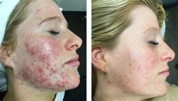 Can bbl treat acne?