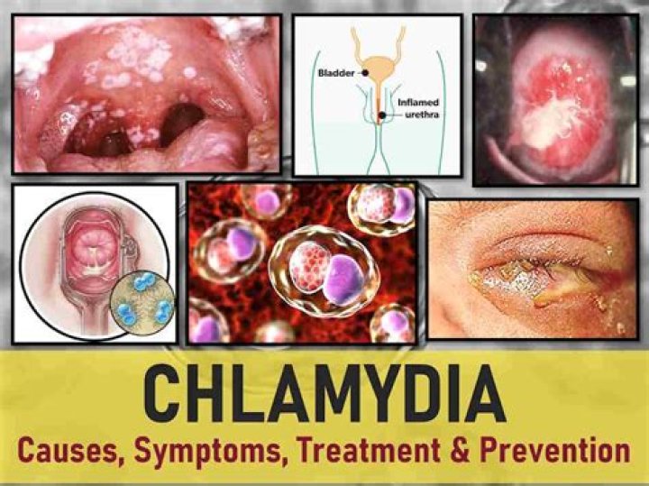 Can chlamydia be cured after 2 years?