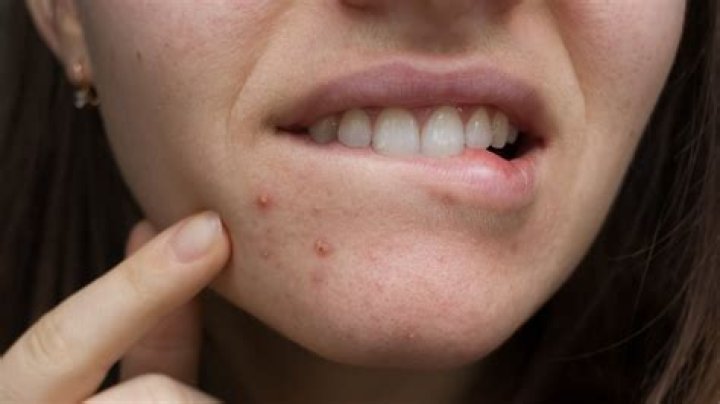 Can eggs cause pimples?