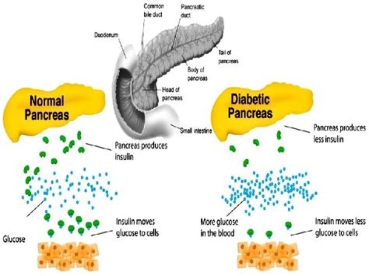 Can fatty pancreas be reversed?