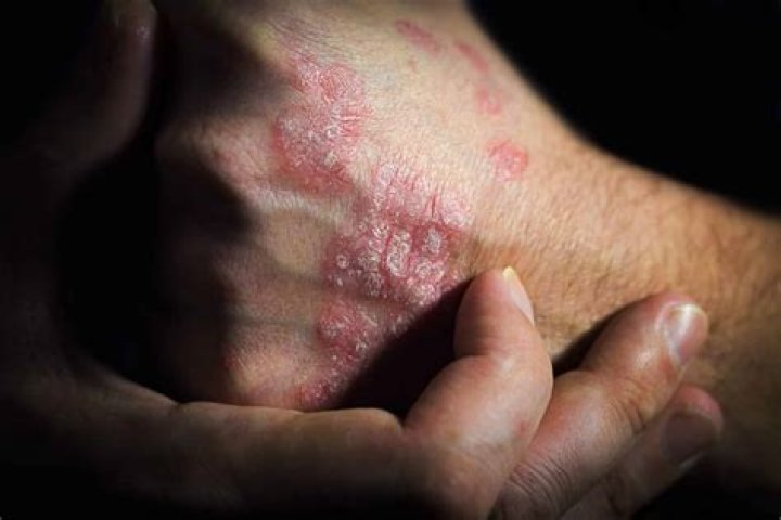 Can psoriasis cause death?