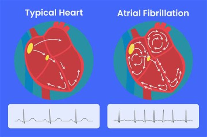 Can too much vitamin D cause atrial fibrillation?