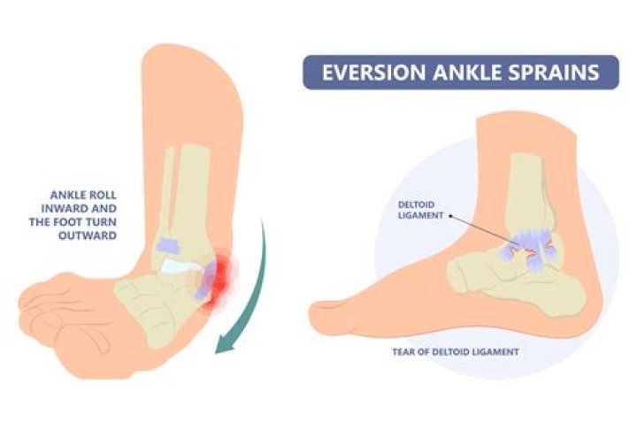 Does a sprained ankle turn red?