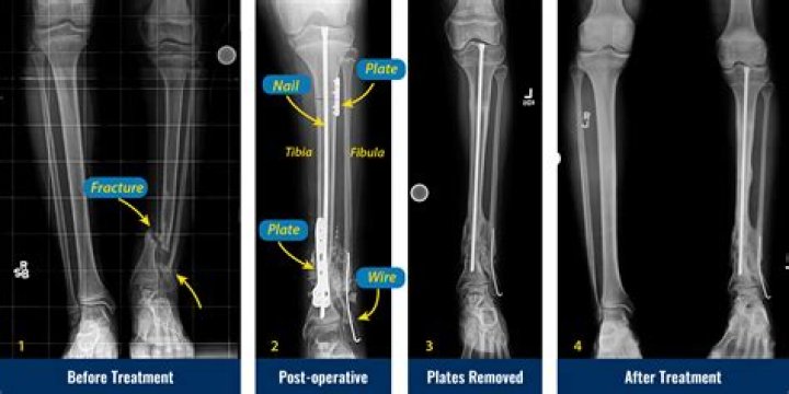 How is a simple fracture treated?