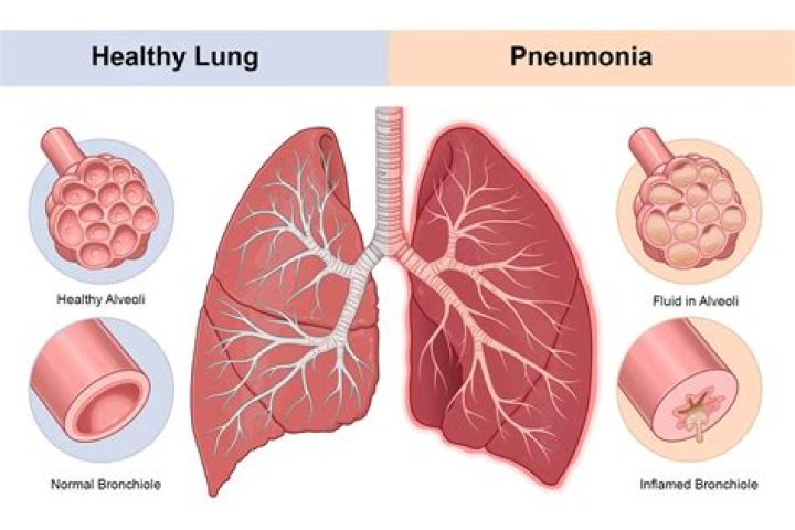 How long can you have pneumonia without knowing?