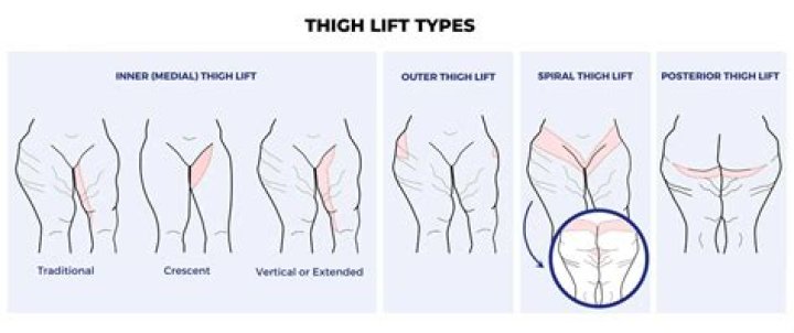 What causes thigh fat in females?