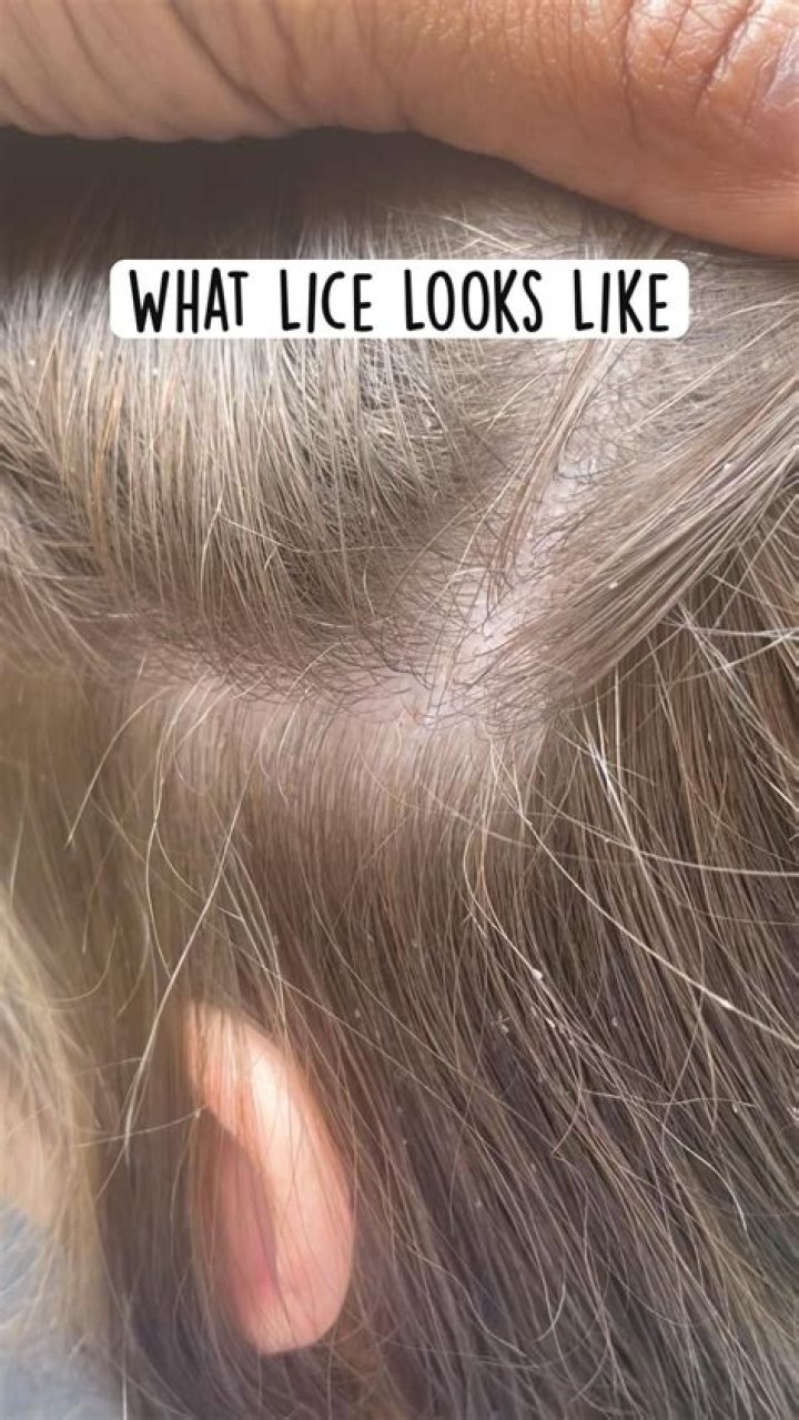 What do lice bites look like on body?