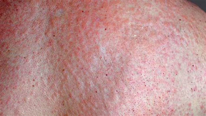 What does a groin rash look like?