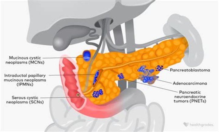 What does a shrinking pancreas mean?
