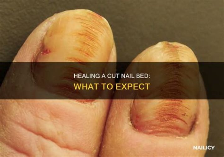 What is a nail bed injury?
