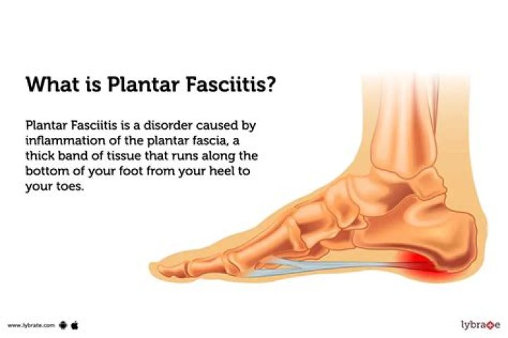 What is fasciitis of the foot?