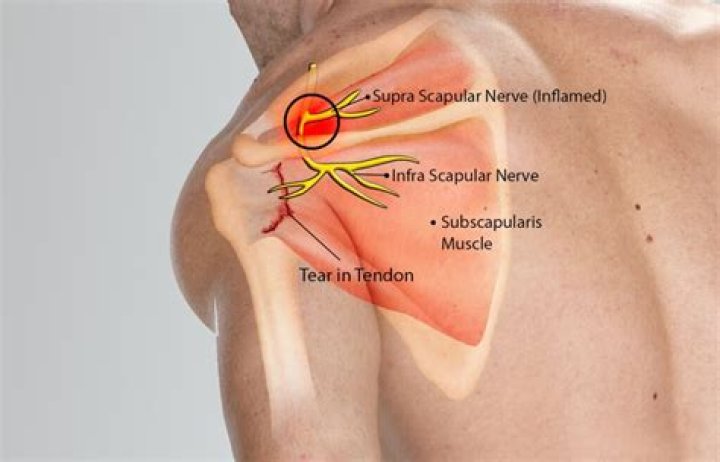 What is Suprascapular nerve entrapment?