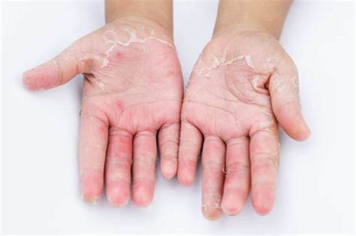 Which type of fungal infection is most serious?